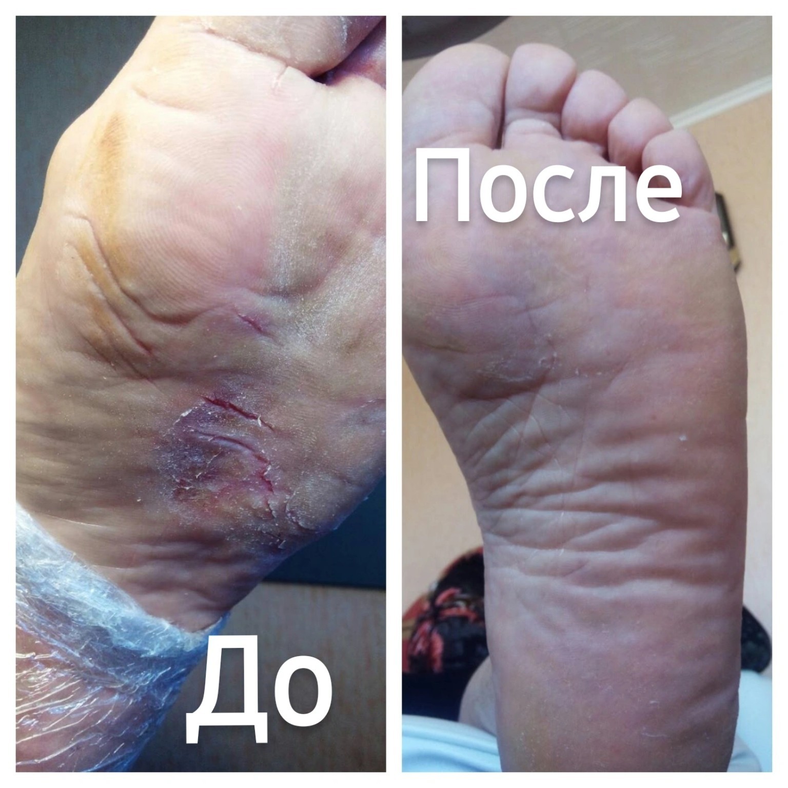Микоз стопы с явлениями дерматита