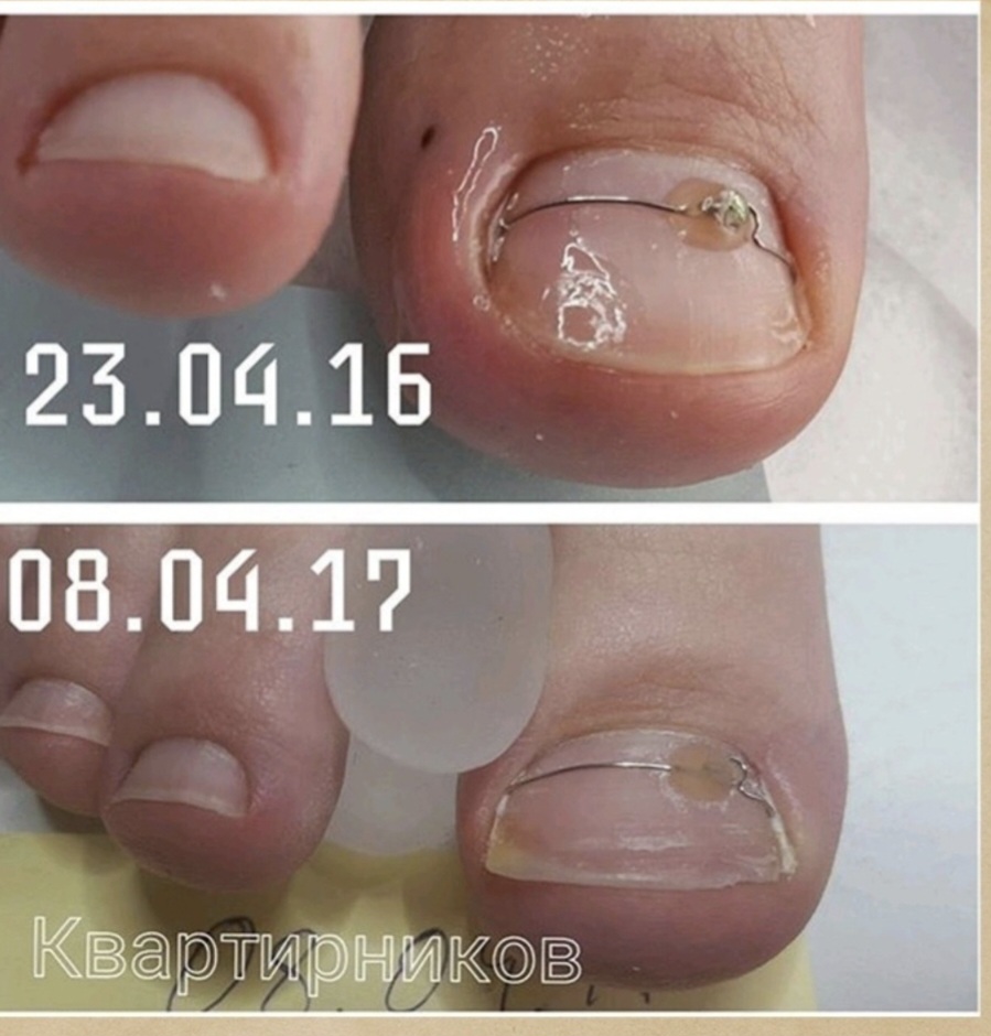 Клинический случай 07 — Одностороннее врастание ногтя